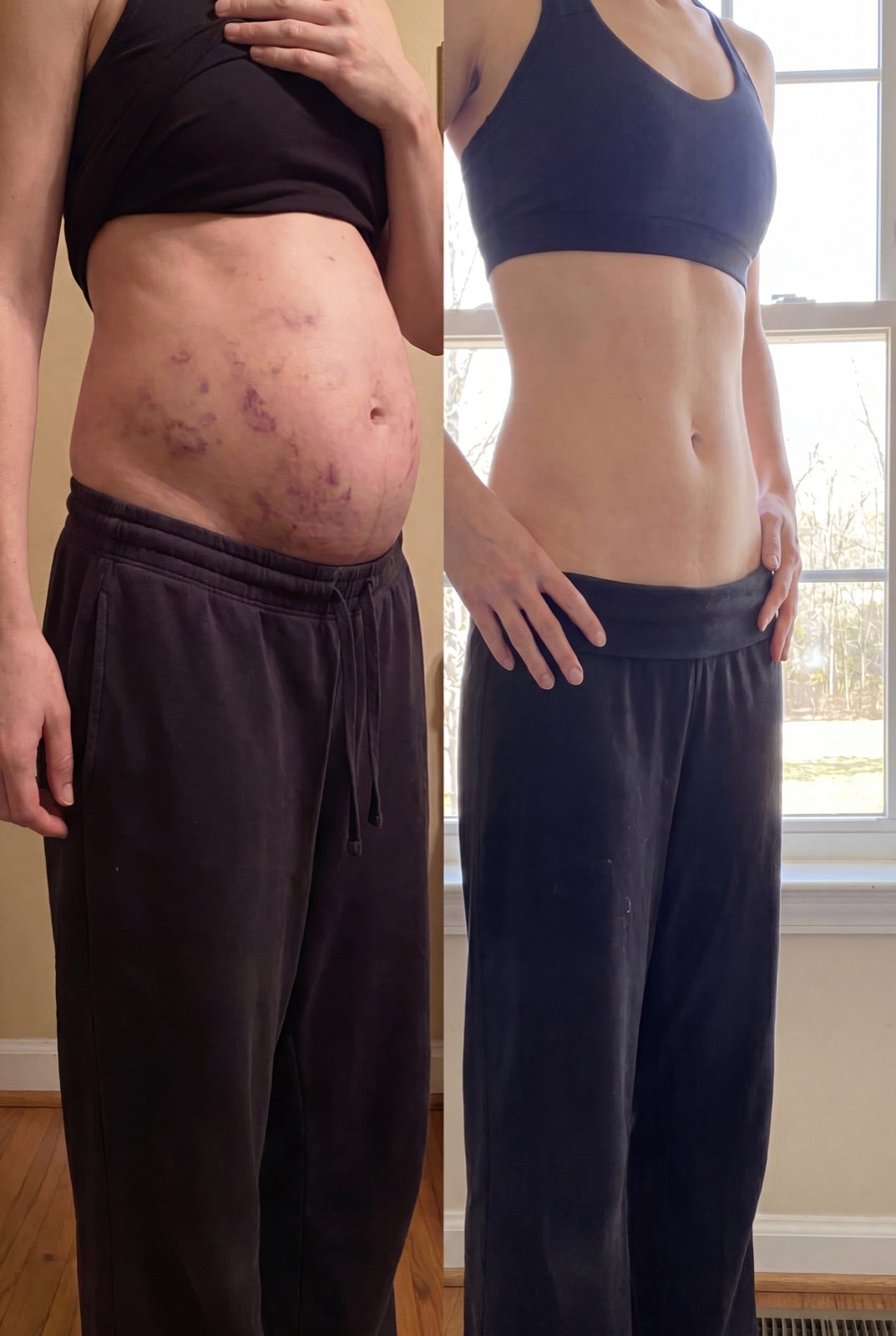 Before and after — Softer, less swollen — without the $150 sessions.