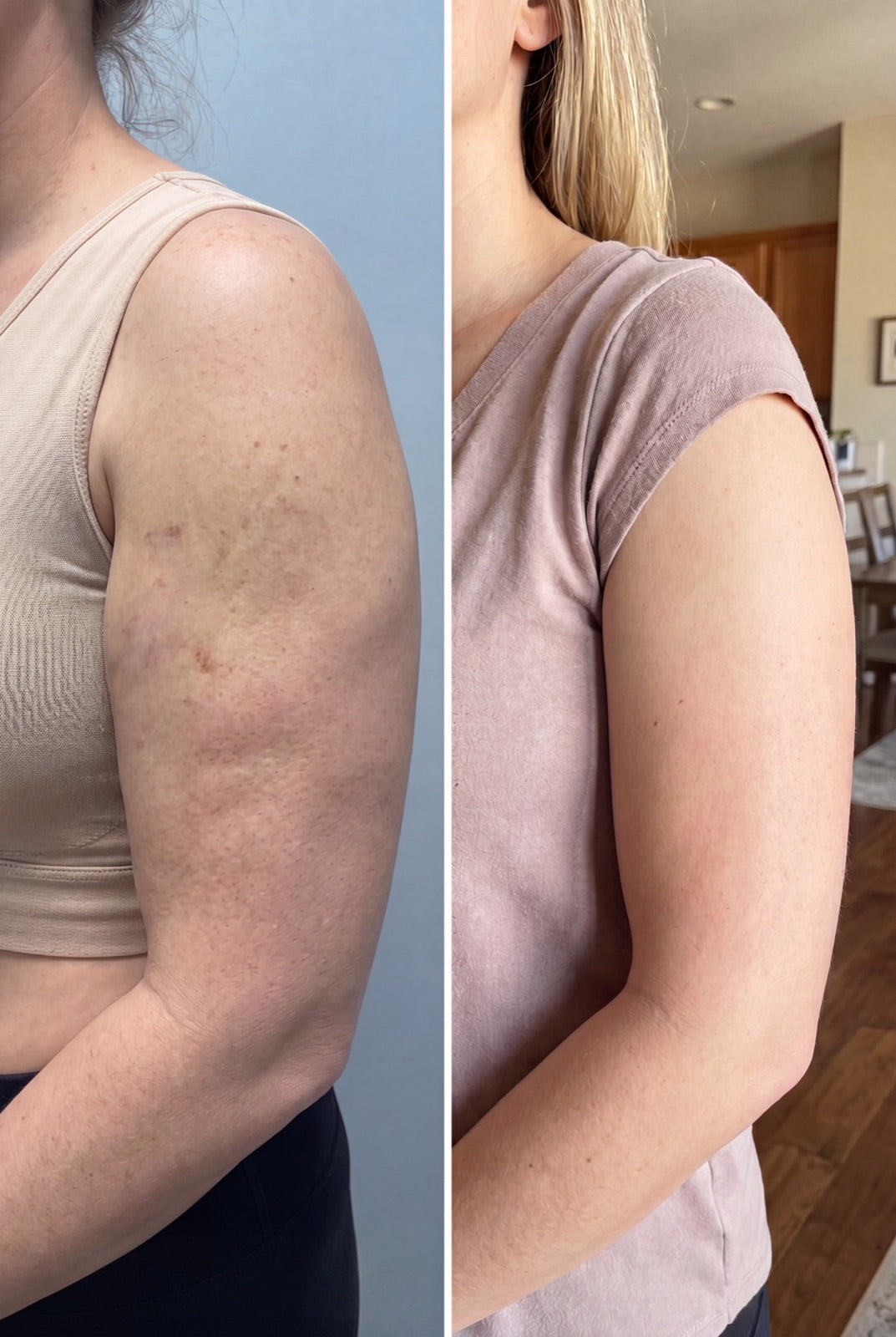 Before and after — Less swollen arms — drainage on her own schedule.