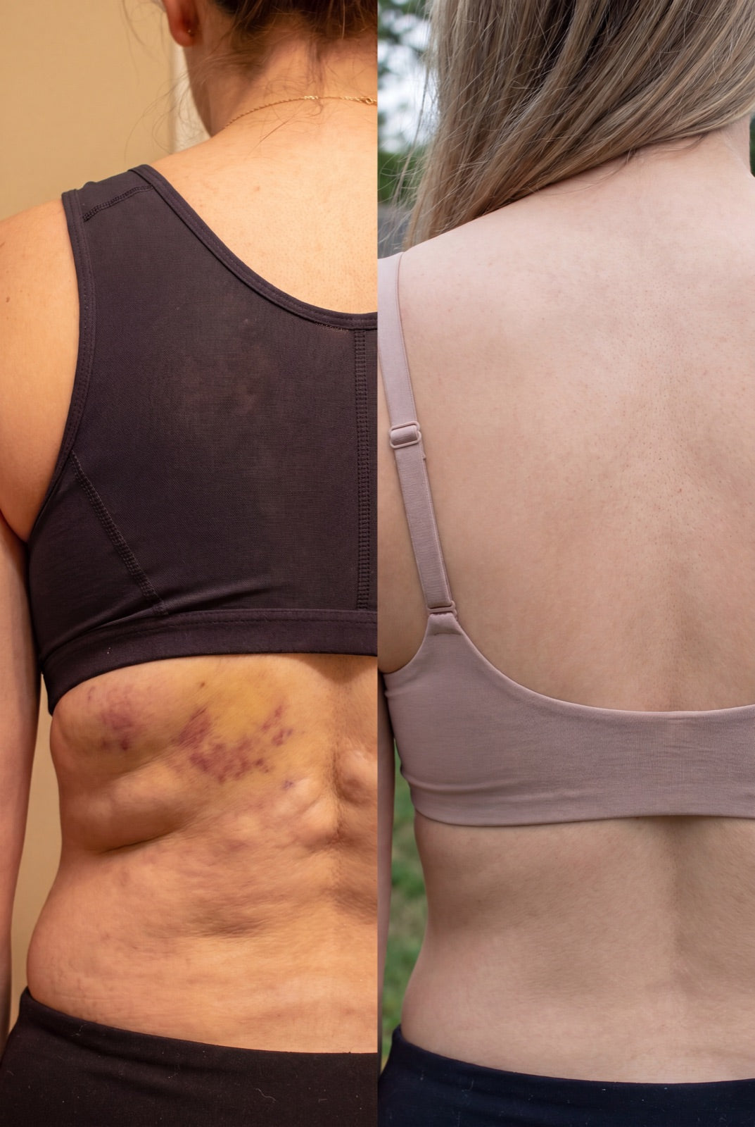 Before and after — Back and flank swelling softening, week by week.