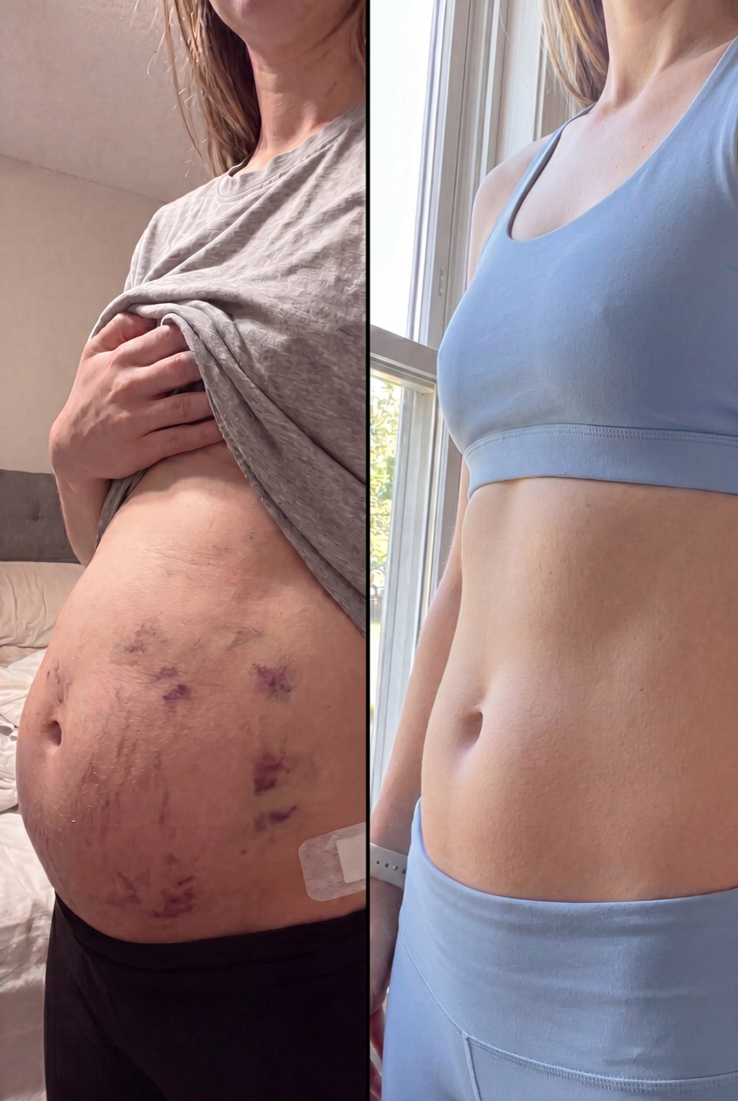 Before and after — A flatter-looking, less puffy midsection — no appointments.