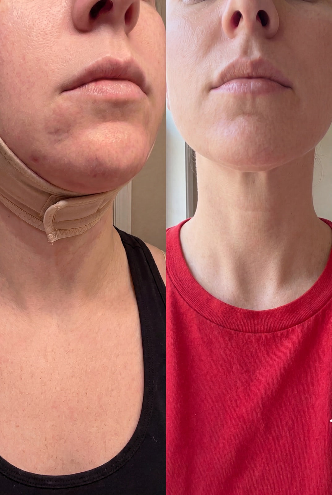 Before and after — Jaw and neck swelling down — at home, not the clinic.