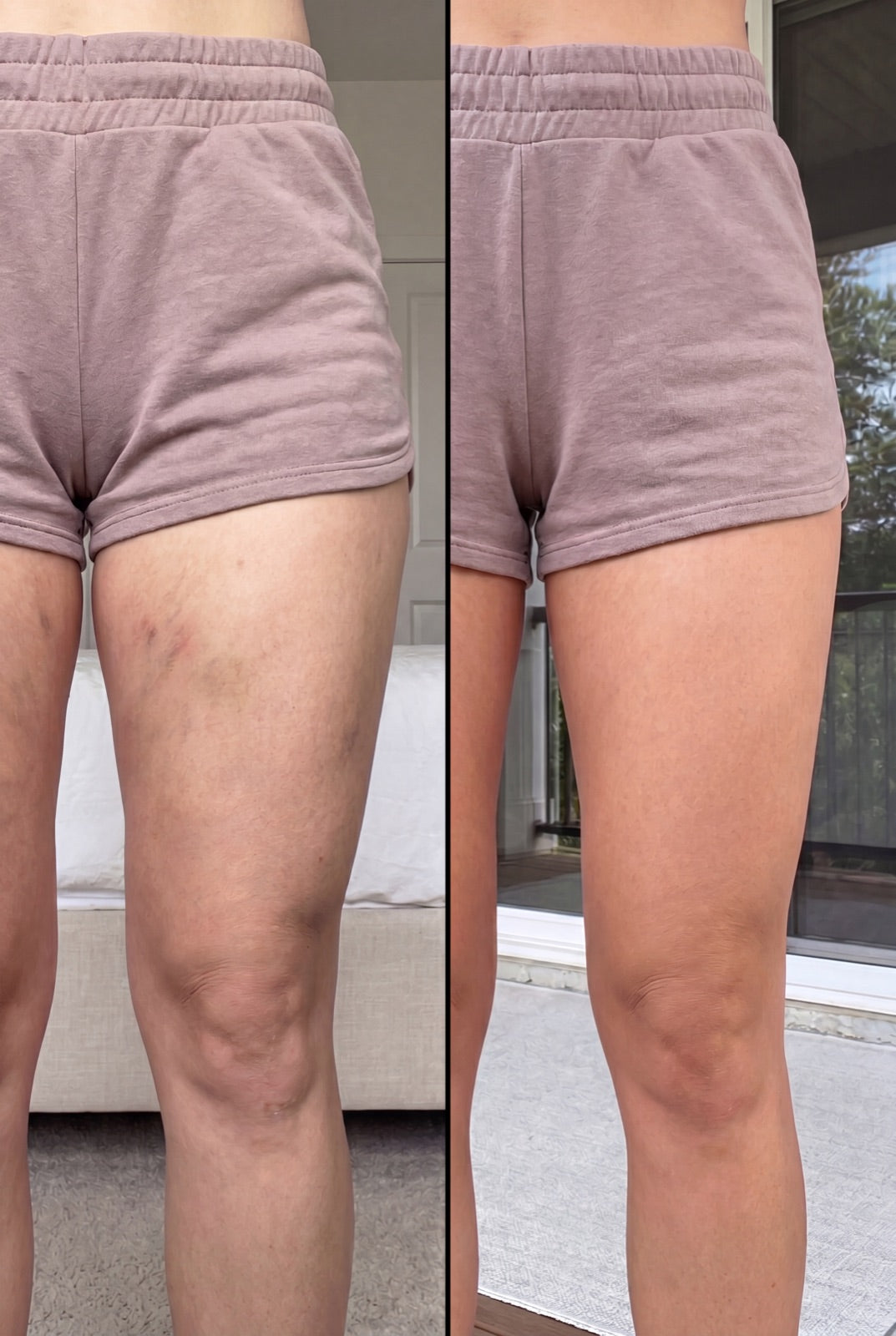 Before and after — Smoother, less swollen thighs between sessions.