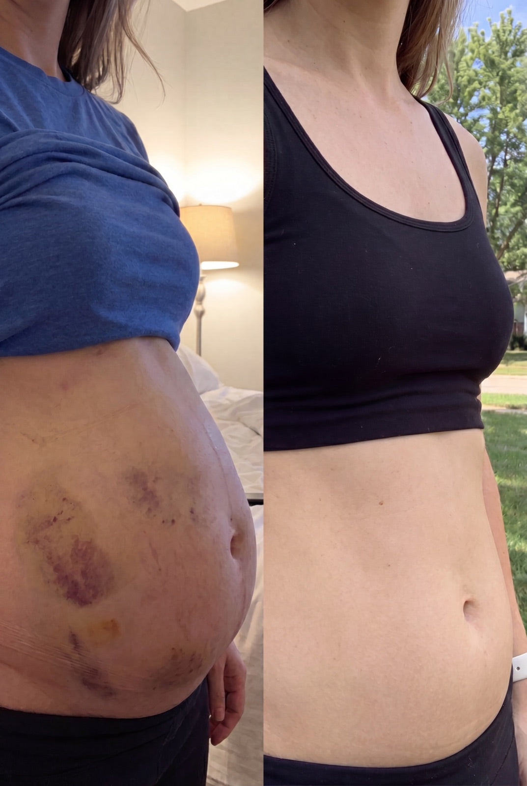 Before and after — A flatter, softer lower belly — no booked sessions.