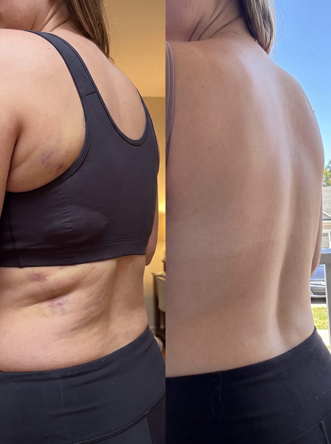 Before and after with Nova — Flank and back bruising cleared, swelling down.