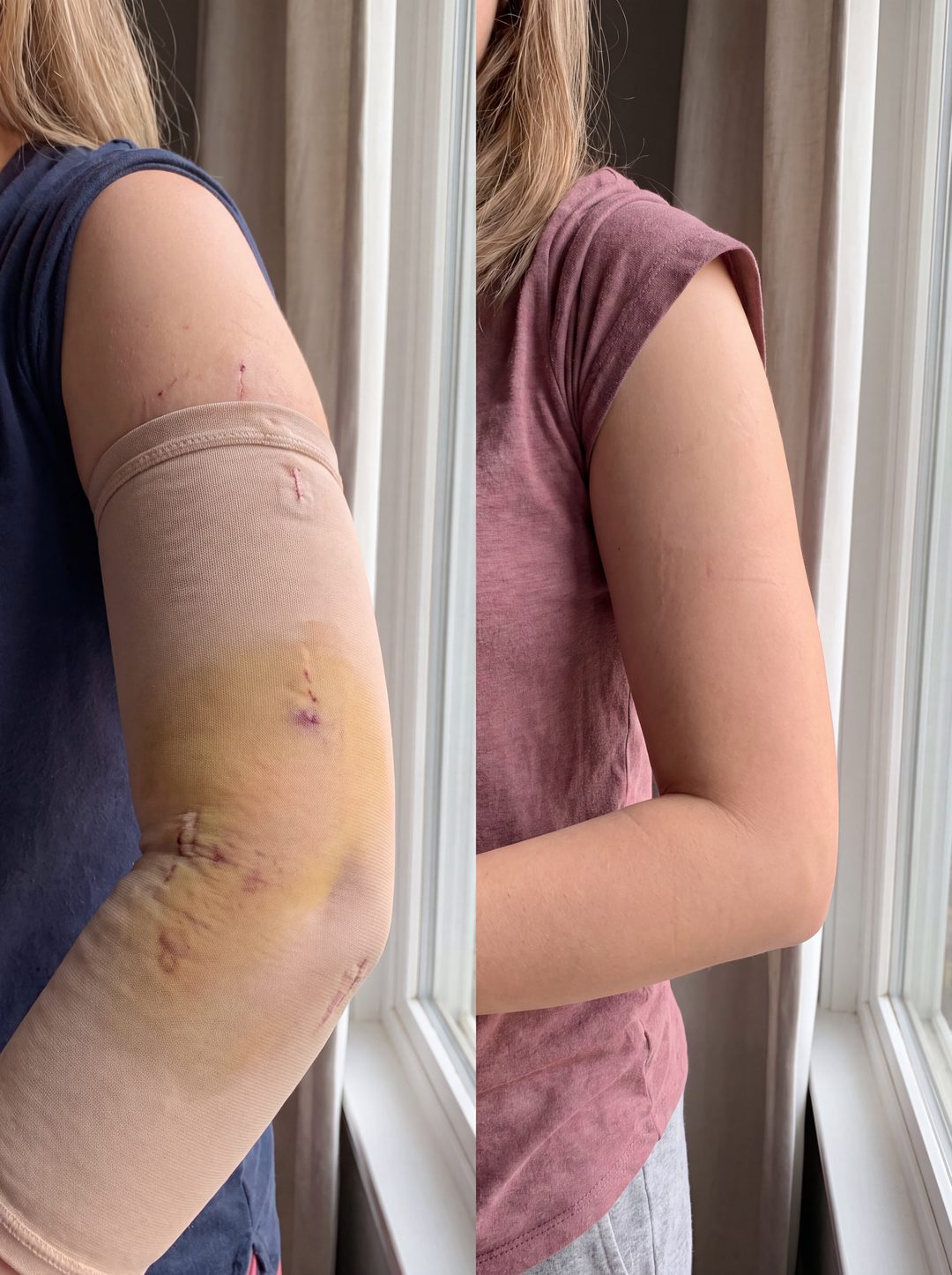 Before and after with Nova — Upper-arm bruising faded, swelling visibly down.