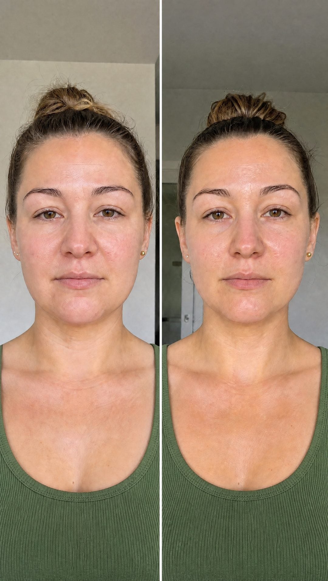 Before and after — Jawline back by morning — puffiness visibly down.