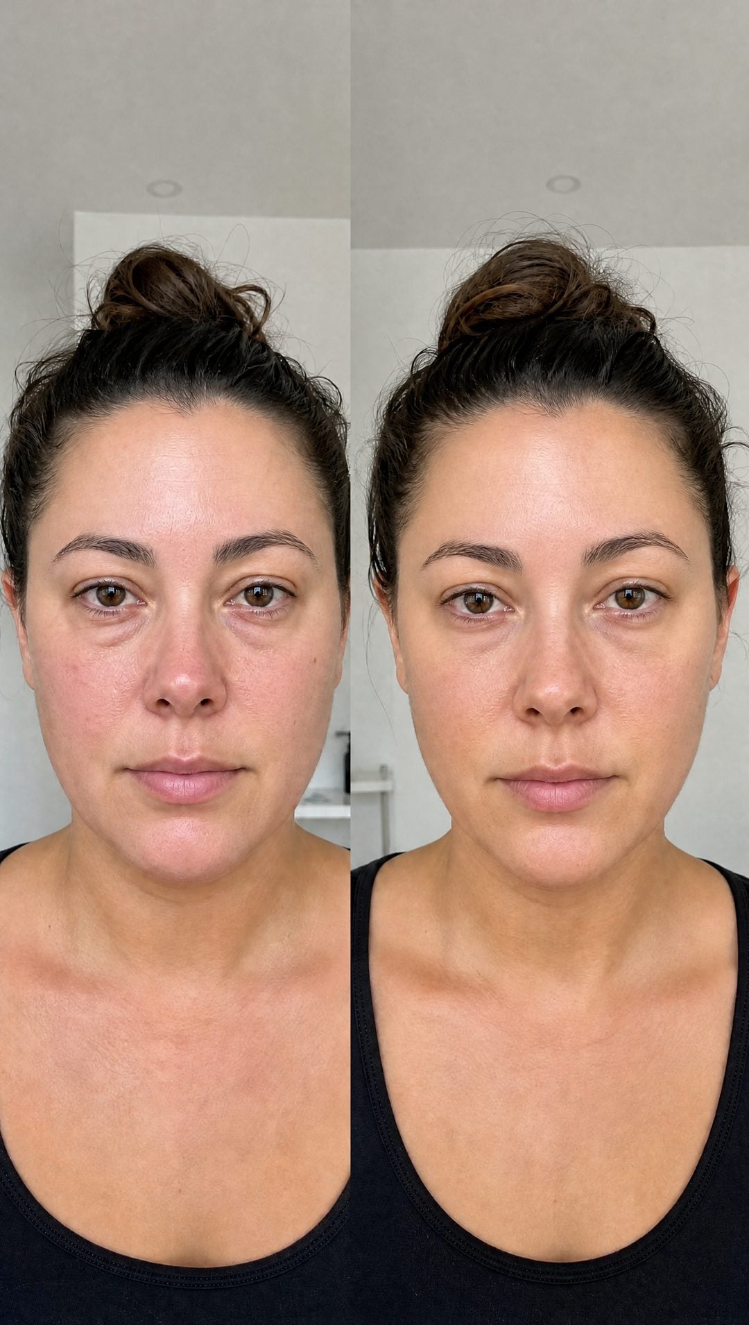 Before and after — Under-eye and cheek puffiness, visibly calmer.