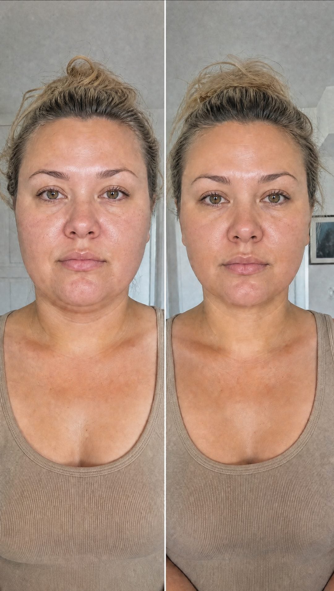 Before and after — Jawline and cheeks, de-puffed and fresher-looking.